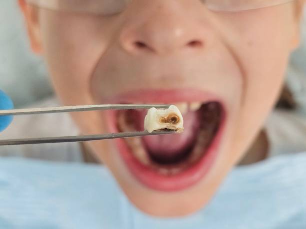 Best Emergency Treatment for Oral Infections in Seffner, FL